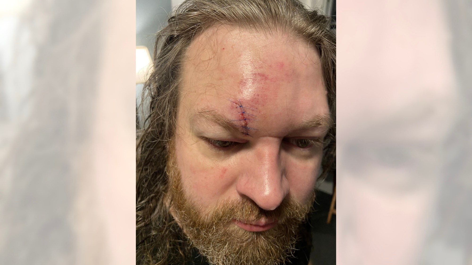 A photo of the victim’s injuries sustained during a brawl at Disneyland on December 30, 2025. (Courtesy of Reddit user Wittwitbarista)
